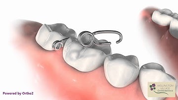 Spring Tooth Separator - Wellington Village Orthodontics