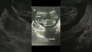 Surrogate SW 19 weeks pregnant