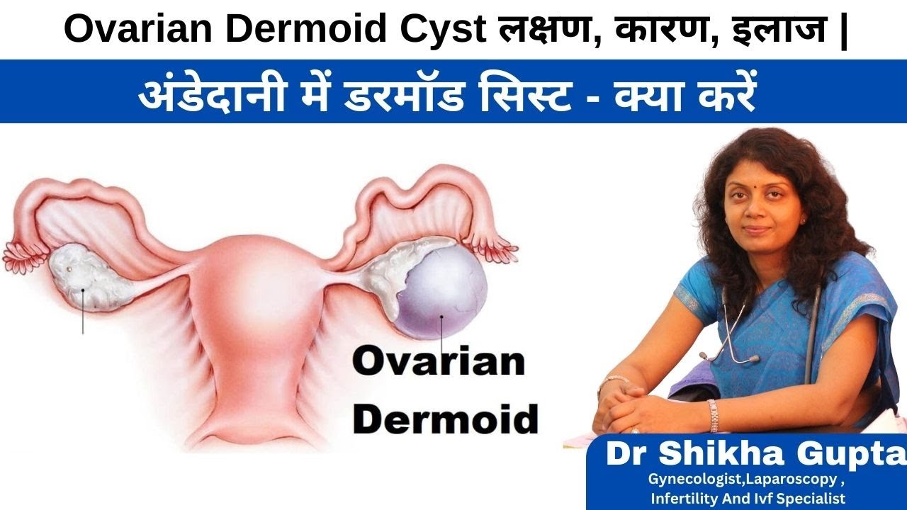 DERMOID CYST IN HINDI Ovarian Dermoid Cyst YouTube dermoid-cyst-in-hindi-ovarian-dermoid-cyst-youtube
