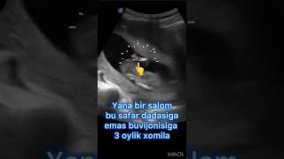 12 Xaftalik Xomila Skrining Tekshiruvi