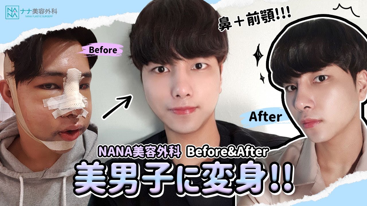 イケメンになりたい 韓国整形 鼻整形 輪郭整形で美男子に変身 Youtube