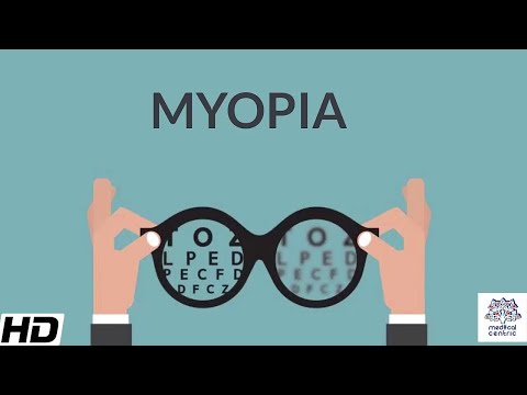 Video: Progressive Myopia In Children - Causes, Symptoms And Treatments