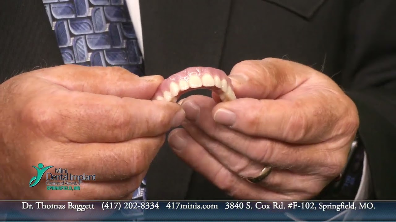 Mini Dental Implants w/ Dr. Baggett in Springfield, MO YouTube