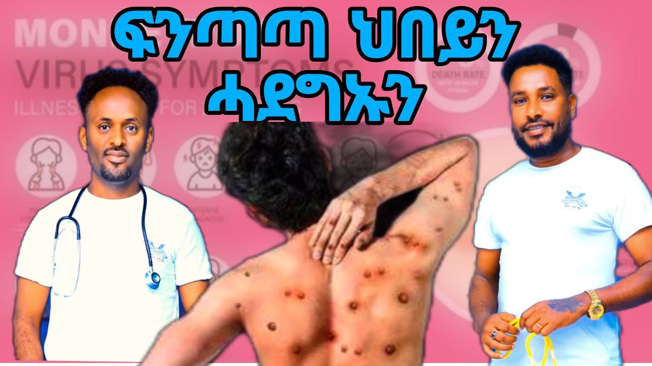 መተሓላለፊን መከላኸሊ ሕማም ፍንጣጣ ህበይ (Monkeypox) ብፆታዊ ርክብ ከምዝመሓላለፍን ኣብ መራብሒ ኣካላትን ሙሉእ ሰብነትን ዕንፍሩር ከምዝወፅእን።