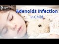 Infected adenoids in children: Signs, Symptoms, Diagnosis - Dr. Satish Babu K