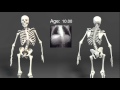 3D Scoliosis Animation