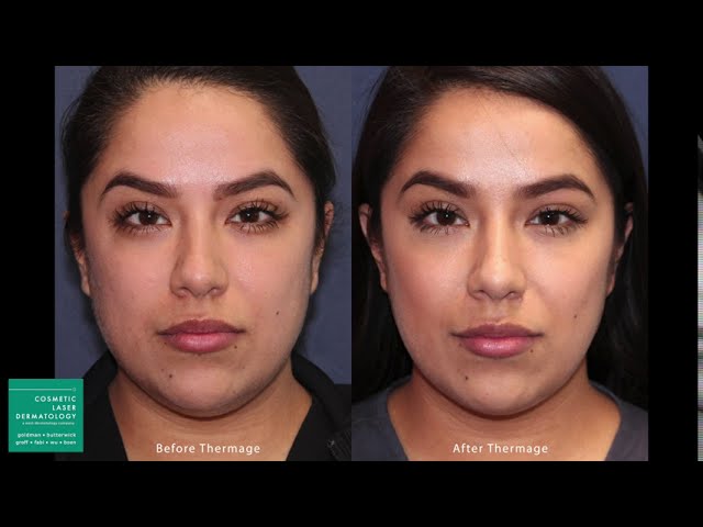 Banner for Thermage Skin Tightening Treatment by Leysin Fletcher, PA-C | Cosmetic Laser Dermatology San Diego