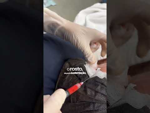 Enxertia de gordura no rosto com Lipocube: como funciona? — vídeo do Dr. Thiago Perfeito