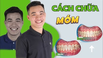 Chỉ sau 6 tháng tình trạng khớp cắn ngược (móm) đã hết hoàn toàn