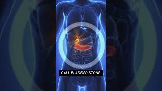 Is it Gallbladder stones Lets find out