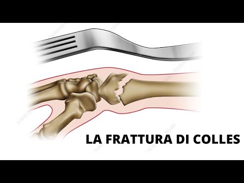 Il percorso riabilitativo nella frattura di Colles