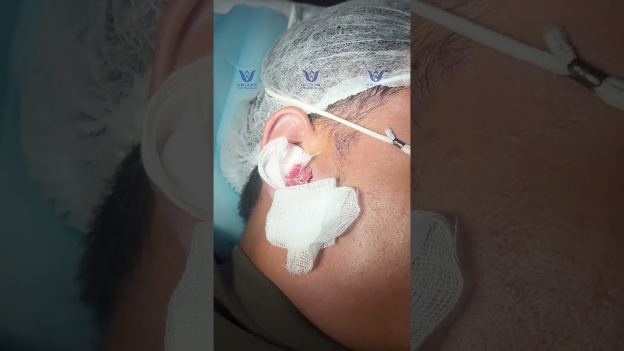 Nặn mụn áp xe ở vùng tai