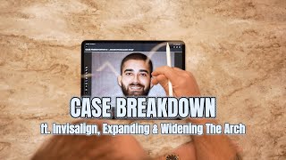 Severe Crowding Fixed Without Braces | 7-Month Invisalign Transformation