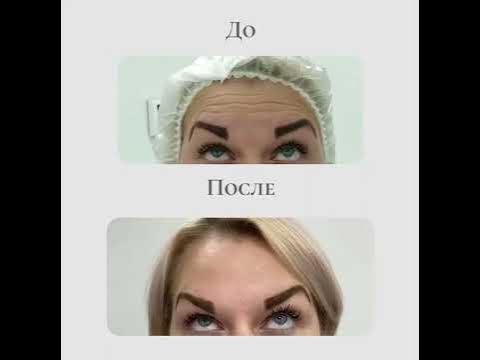Ботулинотерапия: до и после - YouTube