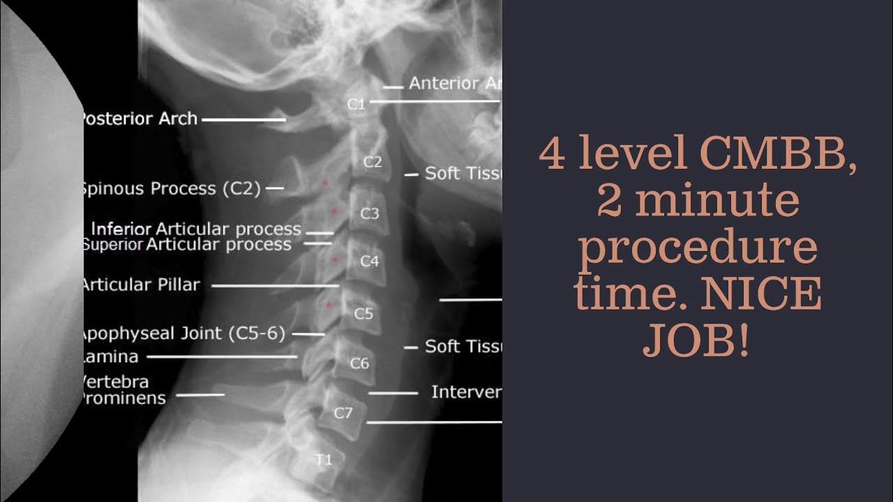 2 Minute Cervical Medial Branch Block YouTube