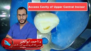 مجمع حلقات ال Access Cavity على قناة الكربولة