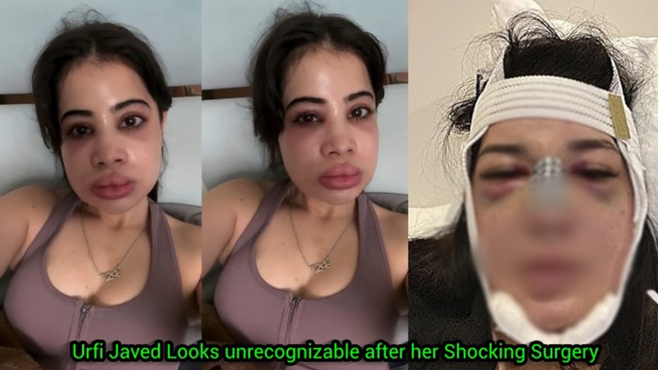 Sad News! Urfi Javed's Face got ruined and Looks unrecognizable after  Plastic surgery gone!