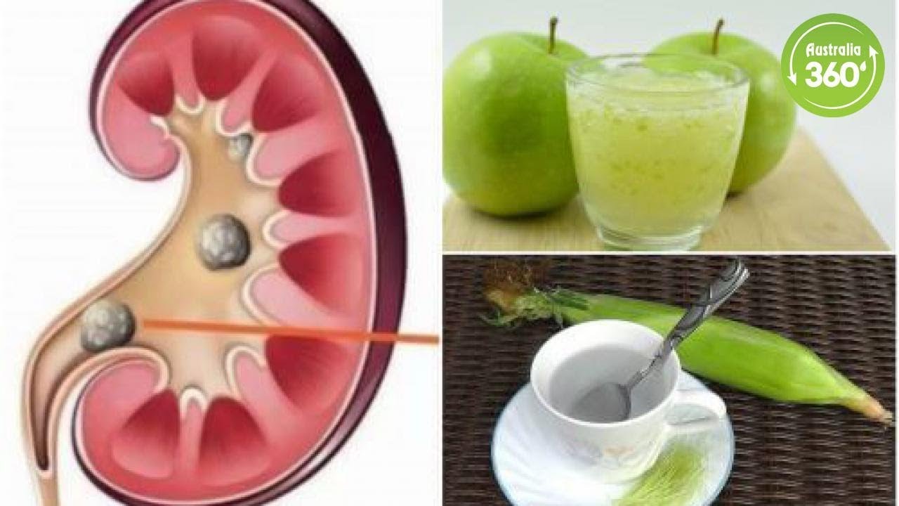 Break Up Kidney Stones by Using These Natural Solutions Australia 360