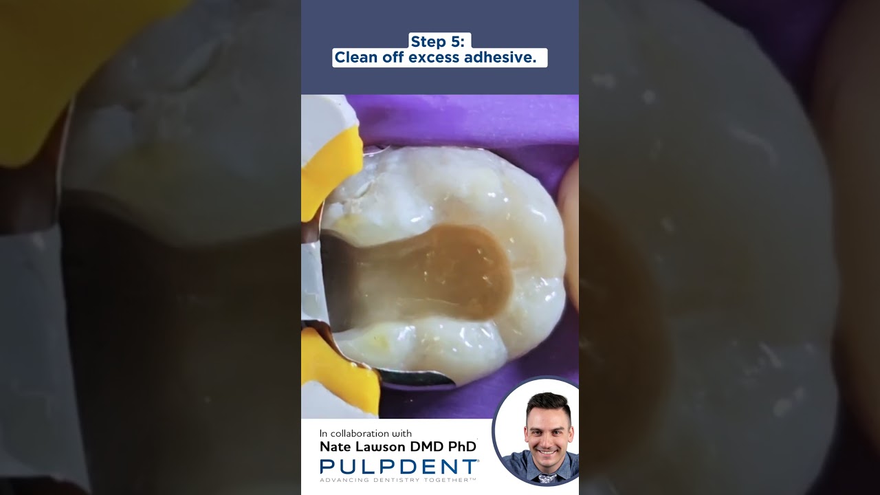 Class II Restoration with ACTIVA™ BioACTIVE RESTORATIVE™