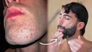 ESSENTIAL BEARD CARE TIPS FOR A HEALTHY BEARD | How To Fix Face Dandruff | Jorge Fernando