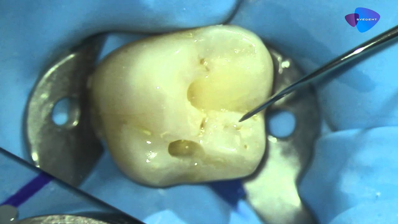 Postendodontic restoration YouTube