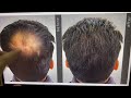 Real result of surminox hair regrowth solution in our patients minoxidil 100 results dr animesh