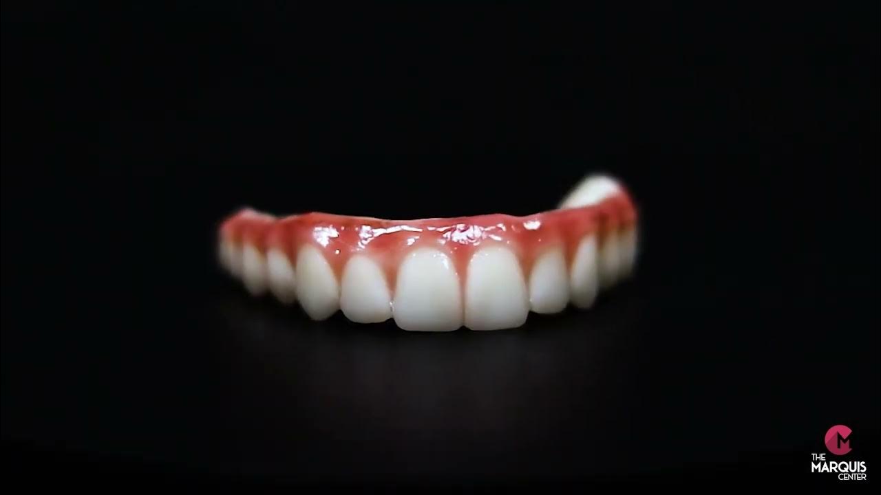 Example of a Marquis Full Mouth Dental Implant YouTube
