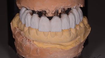 Zirconium crowns IPS E.max Ceram Cut-Back e-max build up