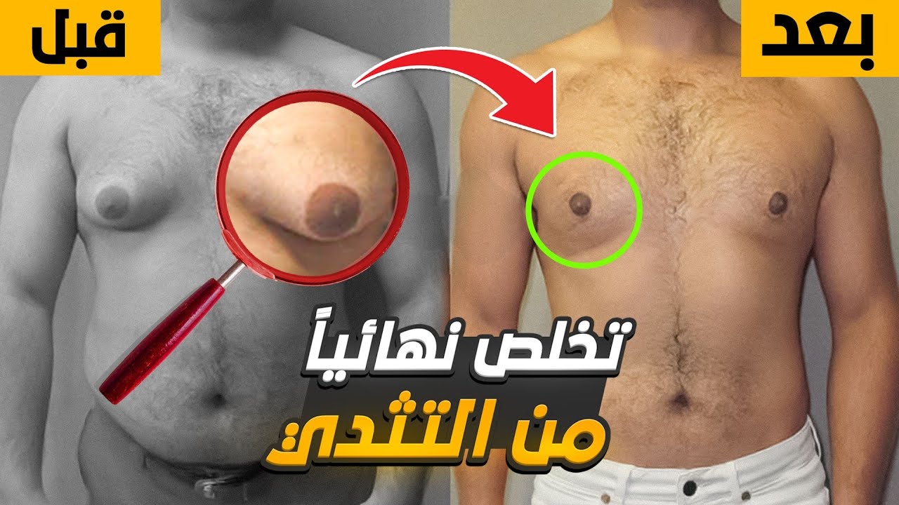 تخلص من التثدي الكاذب بدون جراحة في 3 خطوات بسيطة | فحص بسيط سيجعلك تعرف نوع التثدي لديك وعلاجه