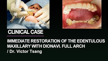 immediate restoration in the edentulous maxillary with DIOnavi. Full Arch