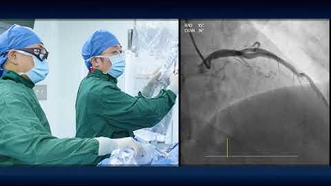 Chronic Total Occlusion (CTO) Case | JACC: Asia Pulse