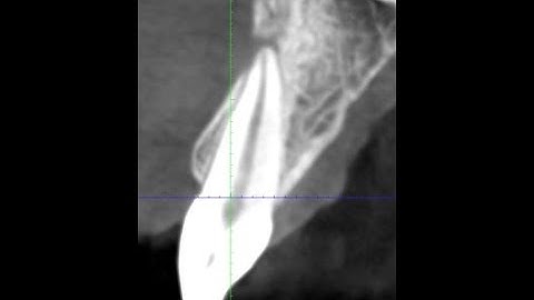 MTA Plug for a Necrotic central incisor with wide apex