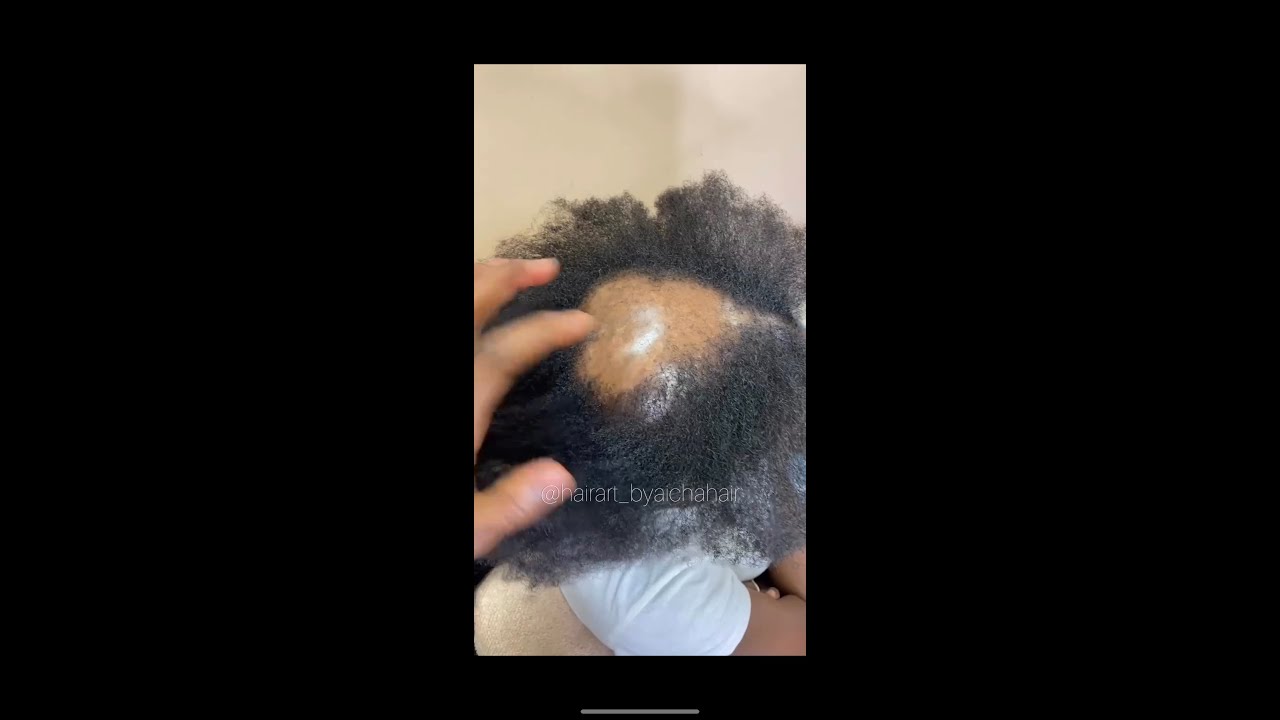 Alopecia braids (Hair loss) YouTube