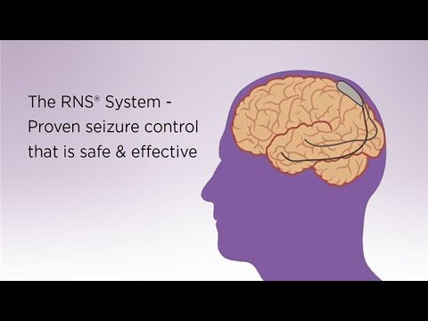 अपने स्रोत पर दौरे का इलाज करना: न्यूरोस्टिम्यूलेशन डिवाइस मस्तिष्क गतिविधि पर नज़र रखता है, दौरे को कम करता है