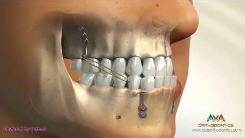 Orthodontic Treatment for Underbite or Crossbite - Bone Anchored Maxillary Protraction