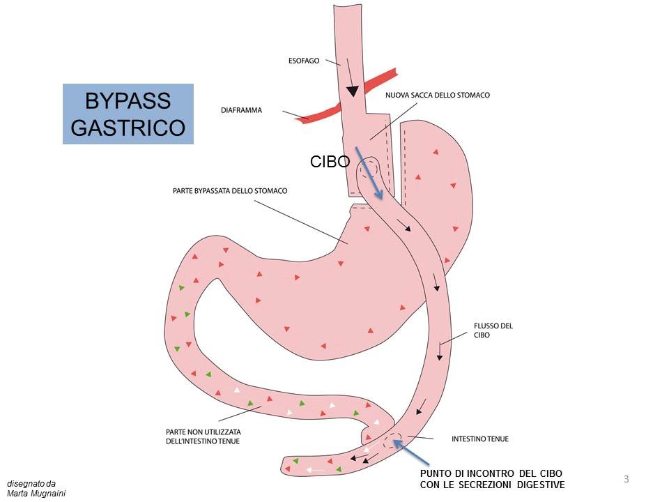 Bypass gastrico precio barcelona