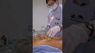 ASMR: Incredible Chinese Electric Acupuncture with Fire Cupping Chiropractic Massage #shorts