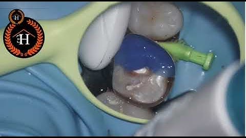 Preendobuildup using circumferential matrix system