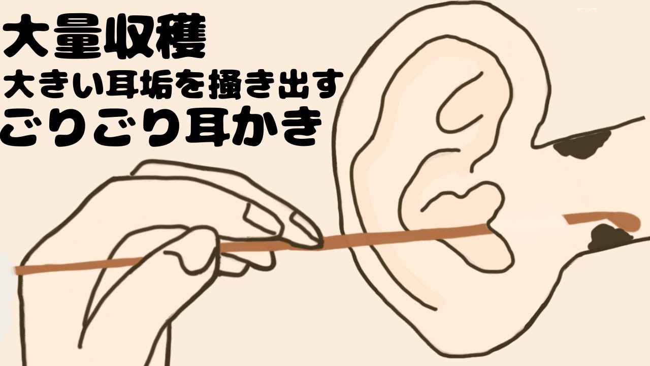 【ASMR】大量収穫大きい耳垢を掻き出すごりごり耳かき Ear Cleaning【No Talking】