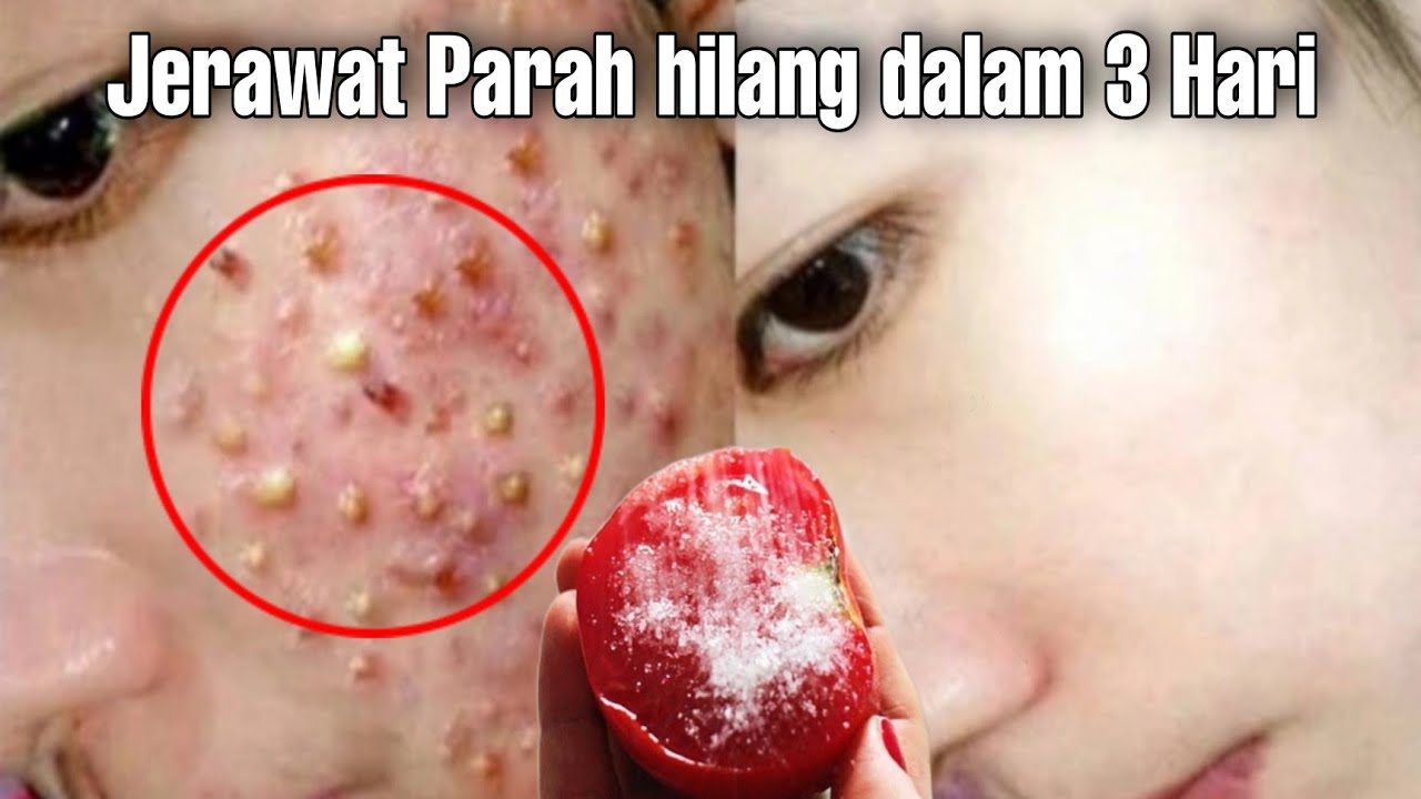 Menghilangkan Jerawat dan Bekasnya: Panduan Komprehensif dengan Pendekatan Spesifik Menghilangkan Jerawat dan Bekasnya: Panduan Komprehensif dengan Pendekatan Spesifik
