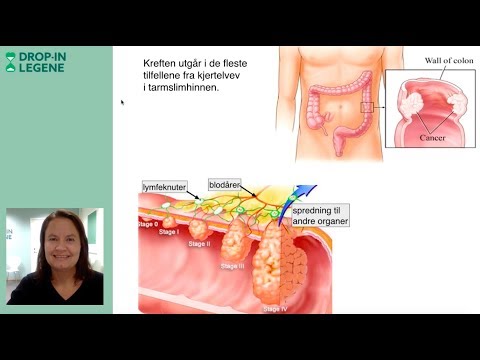 Video: Tykktarmskreft - Tegn, Symptomer, Stadier Og Behandling Av Tykktarmskreft. Hvor Lenge Lever Du Med Tarmkreft?