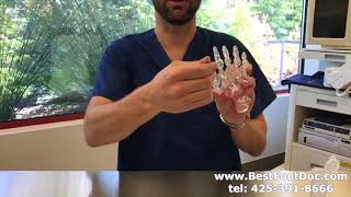 Cartiva Implants -- How they look inside your foot