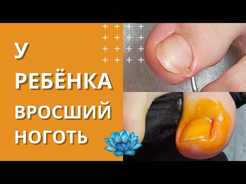 У ребенка вросший ноготь на большом пальце ноги лечение в домашних условиях