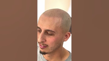 This is after just one scalp micropigmentation session #hairloss #hairtattoo #bald
