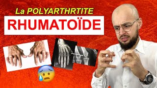 Les symptômes de la POLYARTHRITE RHUMATOÏDE !