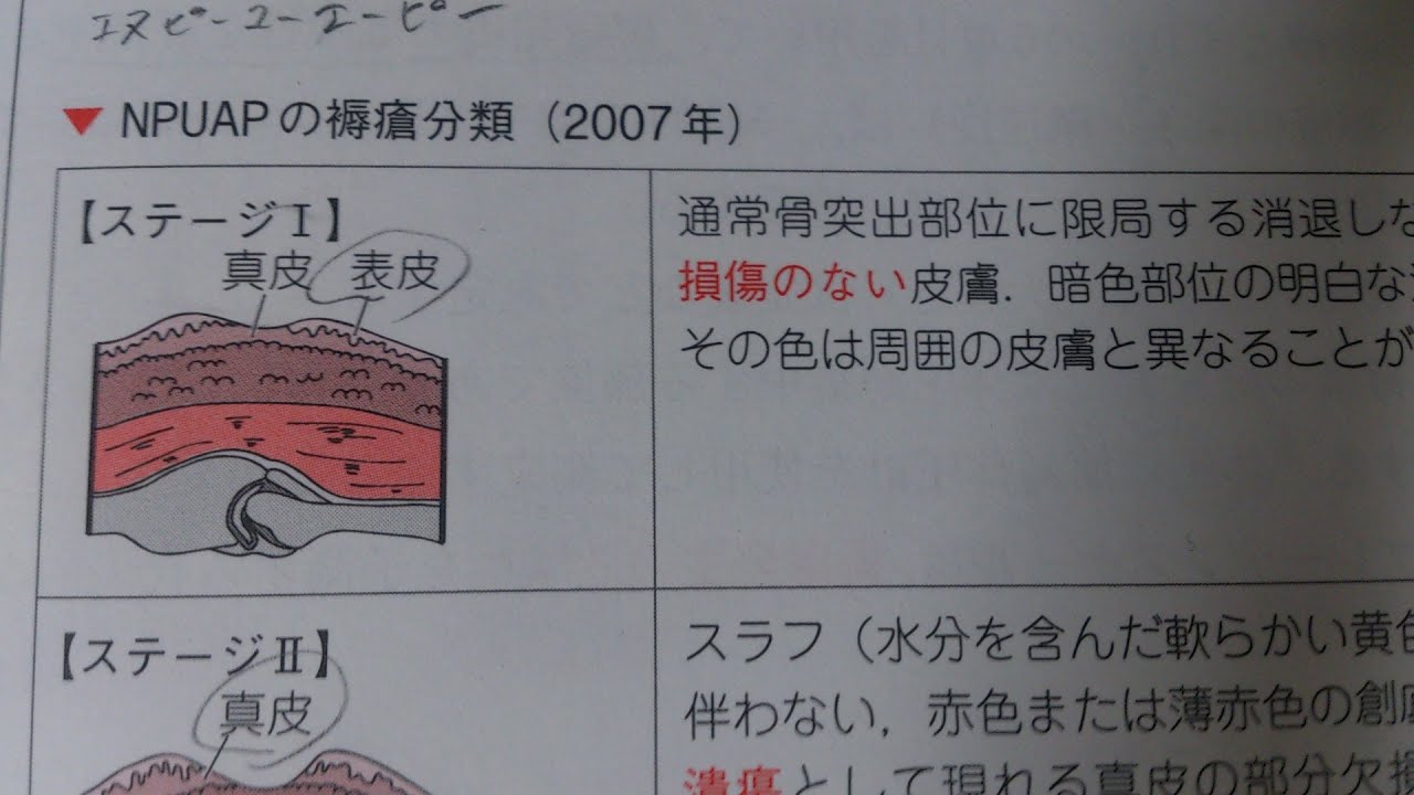 看護学生講座 81 皮膚 Npuapの褥瘡深度分類 の覚えるポイント Youtube 看護学生講座 81 皮膚 Npuapの褥瘡深度分類 の覚えるポイント Youtube