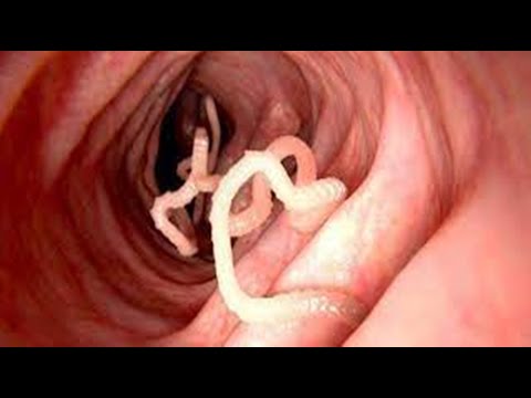 9 Sintomas que podem indicar que você está com vermes intestinais!