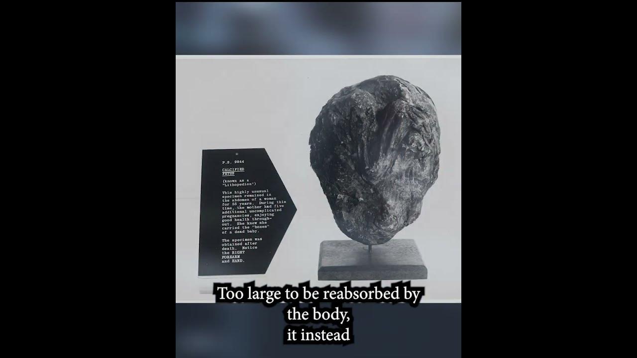 Lithopedions a bizarre and tragic biological phenomenon youtube