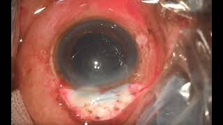 Surgery: Manual Small Incision Cataract Surgery (MSICS): Intracapsular Flipping