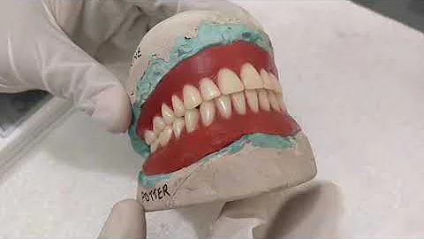 complete Dentures for Adrienne potter
